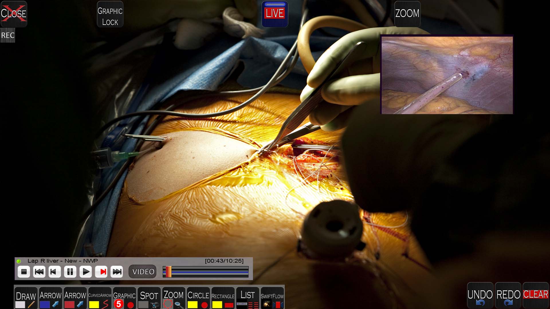 MVC Medical Telestrator with POINT-HD software showing surgery video and picture in picture of live feedback from remote surgeon